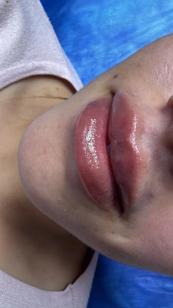 After Treatment