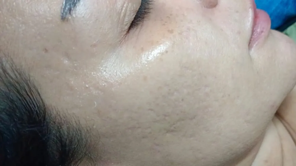 After Treatment