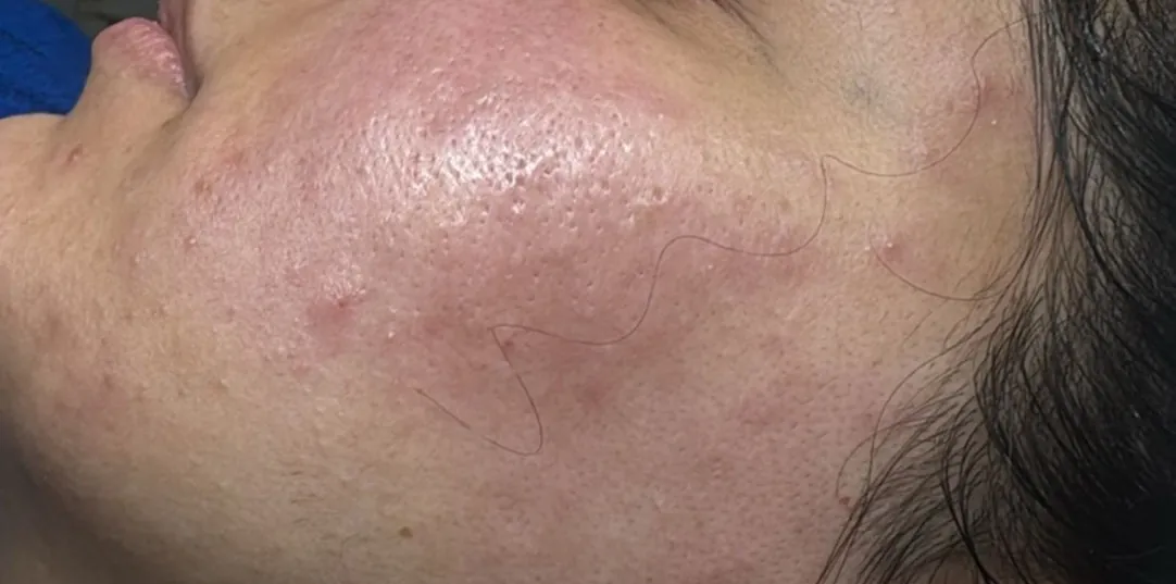 After Treatment