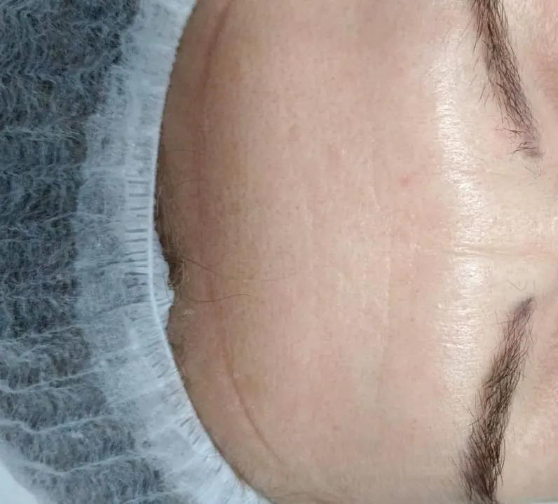 After Treatment