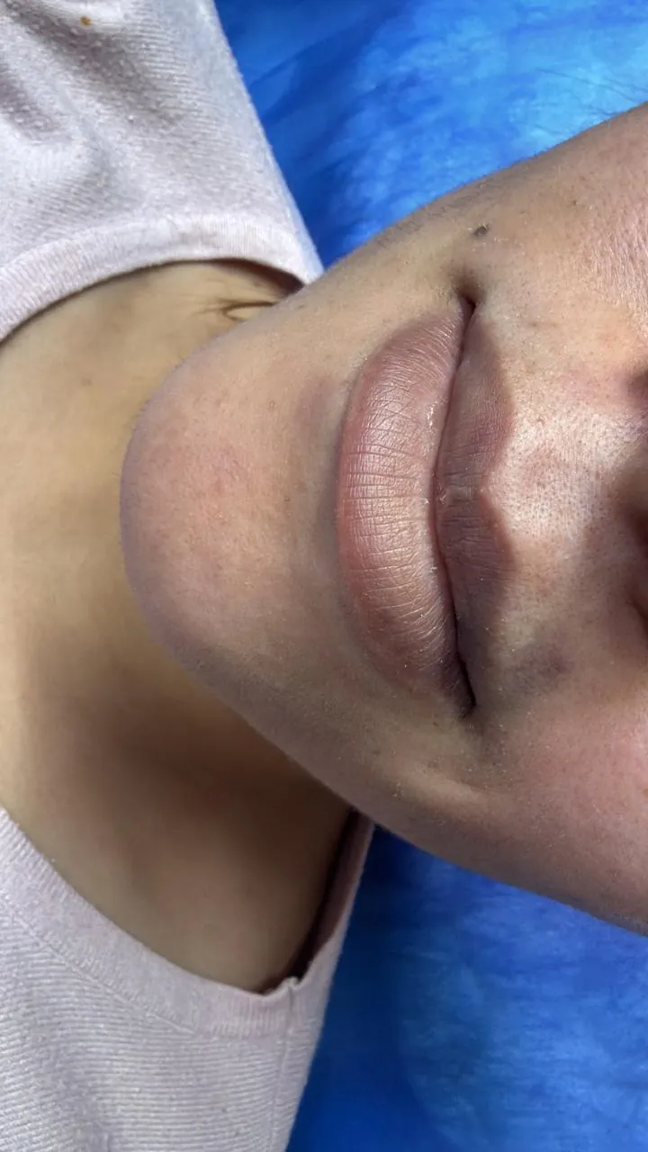 Before Treatment