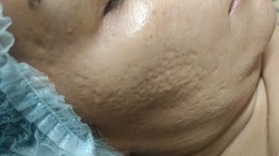 Before Treatment