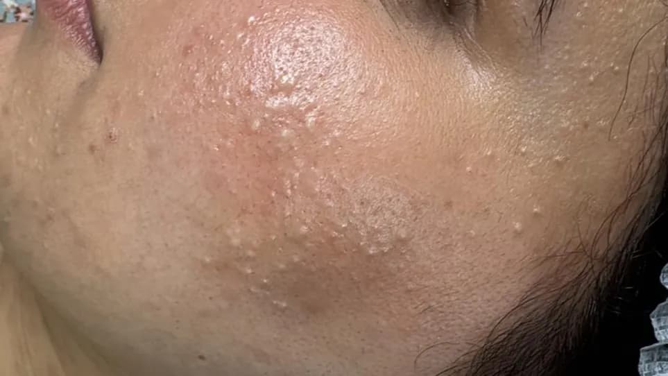 Before Treatment