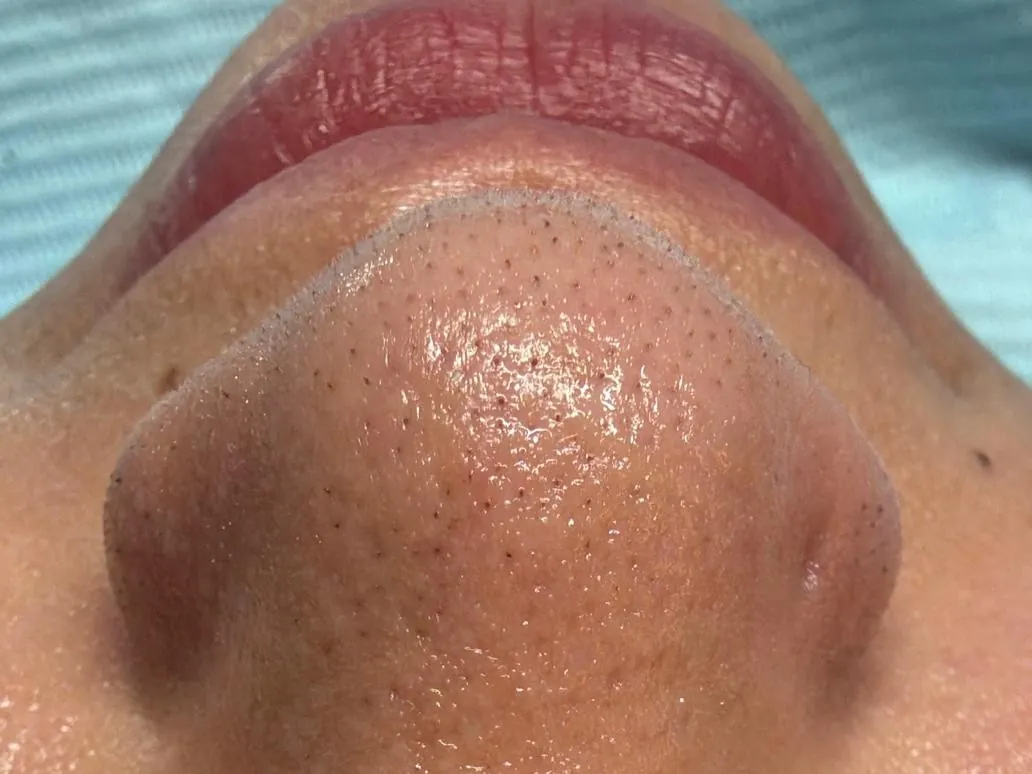 Thumbnail Before