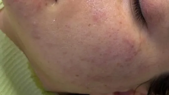 Thumbnail Before