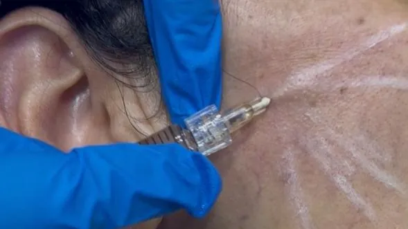 Before Treatment