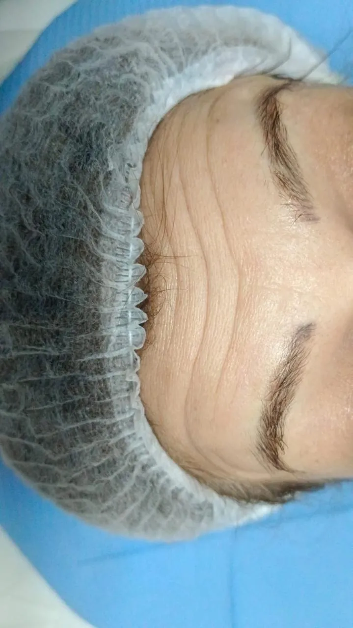 Before Treatment